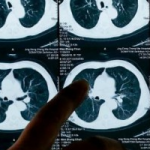 Cancer can now get diagnosed accurately (Artificial intelligence detects cancer tumors with 95% efficiency)